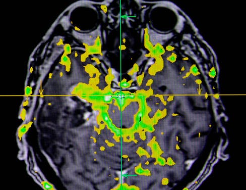 functional brain scan image
